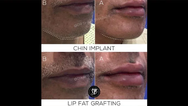 Chin Implant