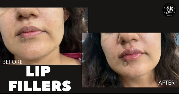 Lip Fillers