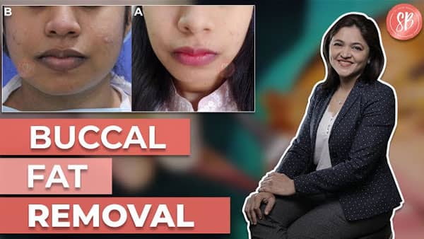 Buccal Fat Removal Surgery | Cheek fat removal | Dr. Shilpi Bhadani