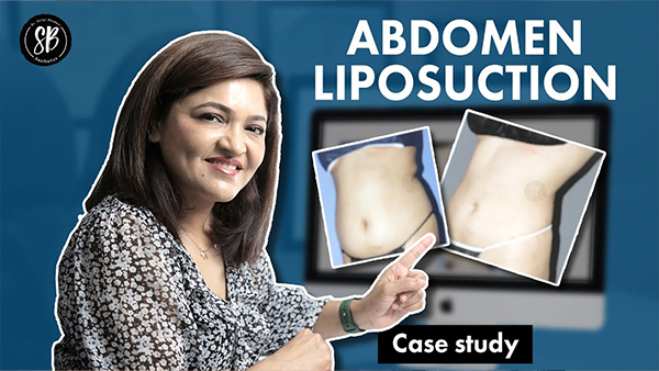 Abdomen Liposuction | Belly Fat Removal Surgery | Dr. Shilpi Bhadani