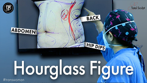 Hourglass Figure Surgery of transwoman | Fat Reduction Surgery | Liposuction & Body Contouring