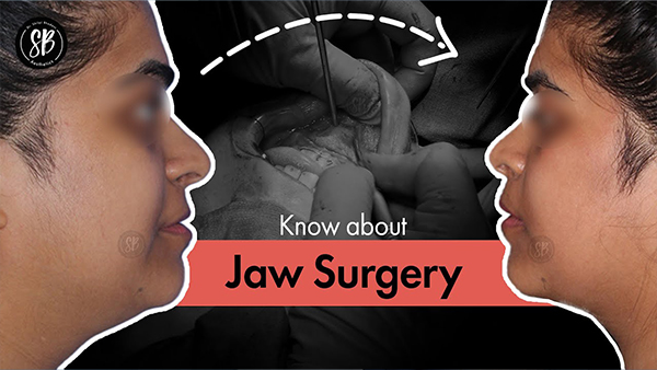A Complete Jaw Surgery Procedure | Orthognathic Surgery | Dr. Shilpi Bhadani