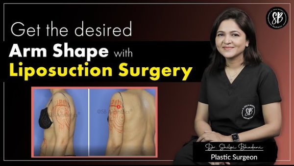 Remove excess fat from the Arms with Liposuction Surgery | Reshape Your Arms | Dr. Shilpi Bhadani