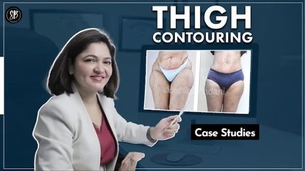 Case study about Thigh Contouring | Liposuction for Thigh | Thigh fat removal | Dr. Shilpi Bhadani