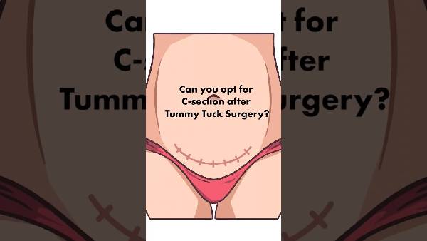 Can you opt for C-section after Tummy Tuck Surgery | Dr. Shilpi Bhadani