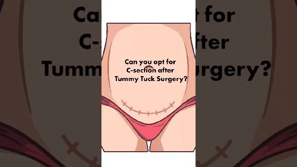 Can you opt for C-section after Tummy Tuck Surgery | Dr. Shilpi Bhadani