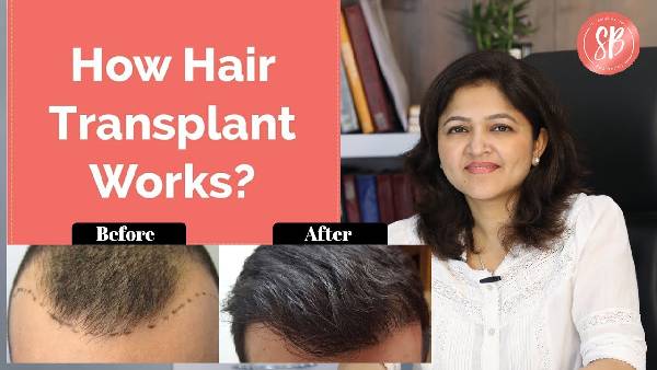 How Hair Transplant Works | Procedure of Hair Transplant | Hair Transplant Clinic in Gurgaon