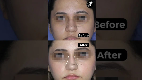 Rhinoplasty Before and After | Rhinoplasty Surgery Results