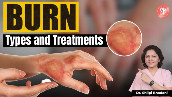 Types of Burns & Treatment Options | Burn Scar Treatments | Dr. Shilpi Bhadani | SB Aesthetics