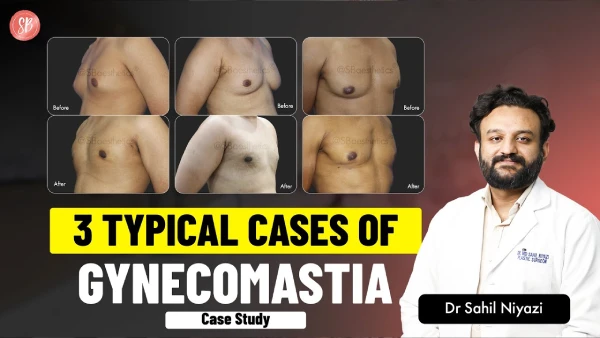 3 Common Gynecomastia Cases Explained | Man Boobs Treatment | Dr. Sahil Niyazi | SB Aesthetics