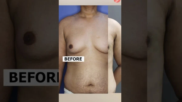 Gynecomastia Surgery Results | Gynecomastia Before & After