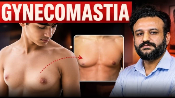 What is teenage gynecomastia | Teenage Gynecomastia: Natural Recovery or Surgery? | SB Aesthetics
