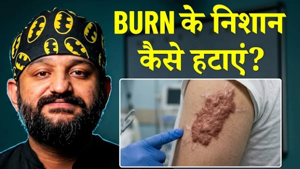 जले के दाग हटाने का सही इलाज | Burn Scar Treatment | Dr. Sahil Niyazi