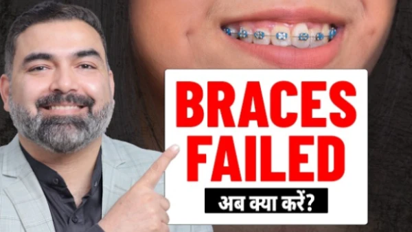 Braces vs Jaw Surgery: Who Really Needs Both? Complete Guide | SB Aesthetics
