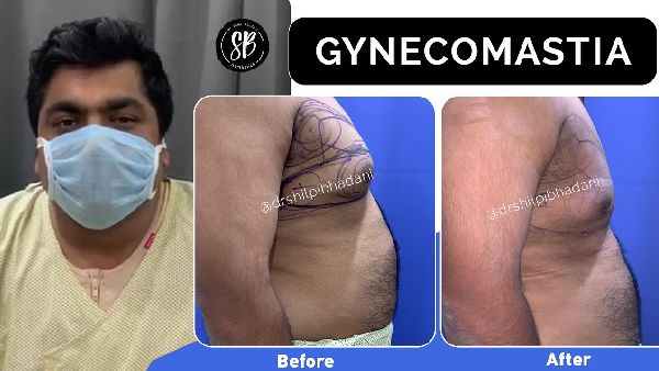 Gynecomast surgery before and after | Patient Testimonial