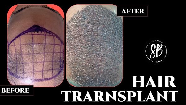 Hair Transplant Surgery Before and After | Hair Transplantation Procedure, Results & Testimonial