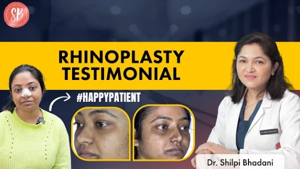 Rhinoplasty testimonial | Nose job before and after | SB Aesthetics